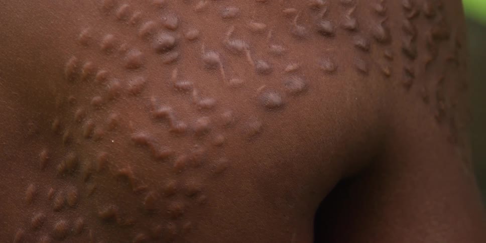 A scarred arm and chest