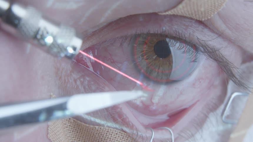 A laser cuts into an eyeball during surgery