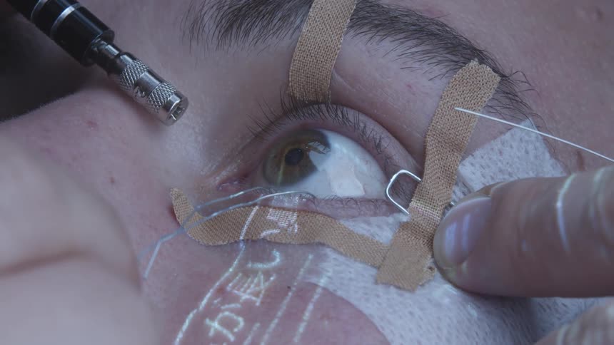 A needle and other tools work together in a surgery on a white persons eye