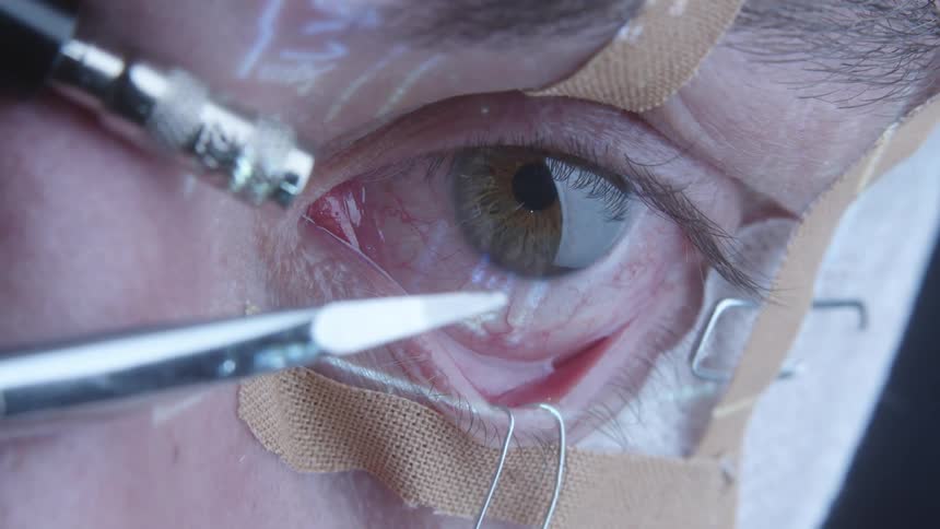 Extreme close up of surgical equipment used on eye and eyelids