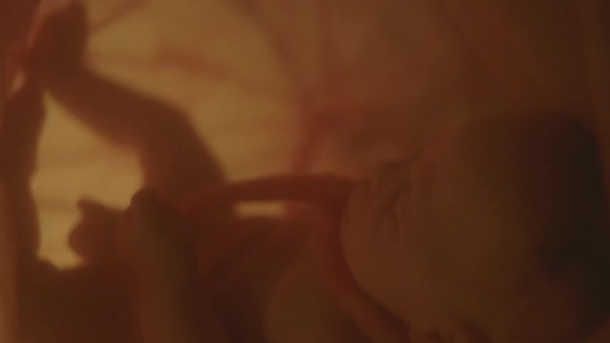 Entanglement of the cord wrapping around the babys neck in the womb