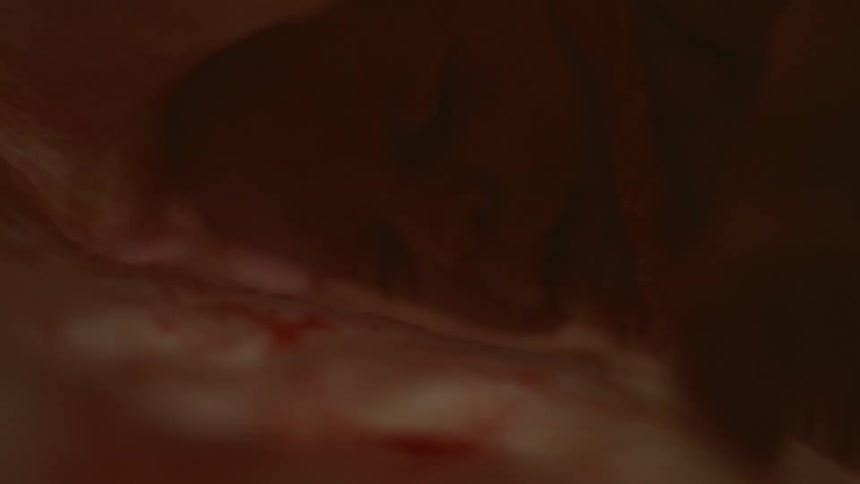 A fetus floating in a uterus has its umbilical cord around its neck