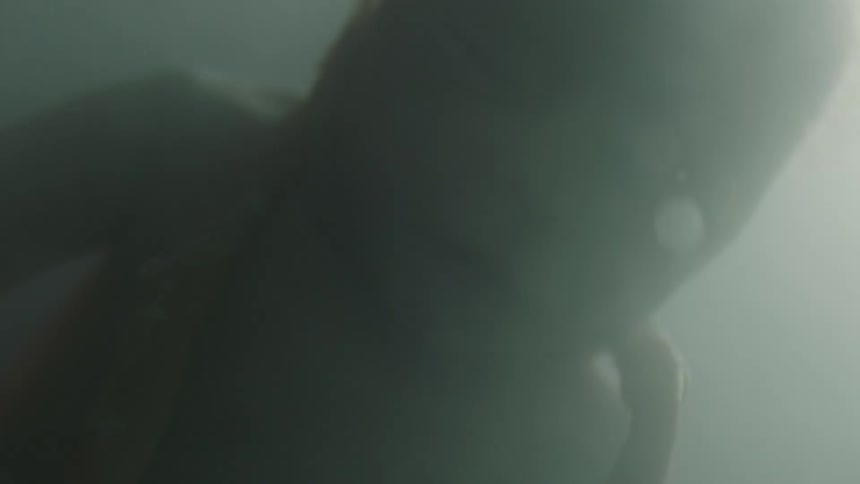 A fetus floating in amniotic fluid has its umbilical cord around its neck