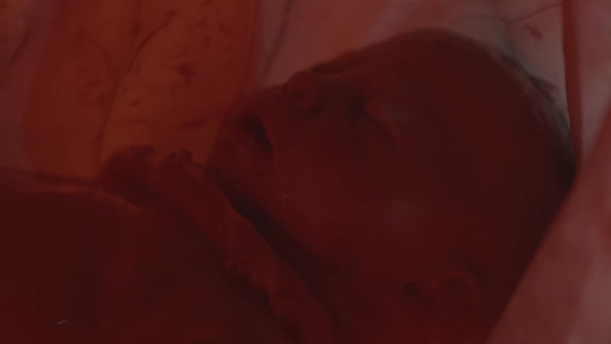 Entanglement of the cord wrapping around the babys neck in the womb