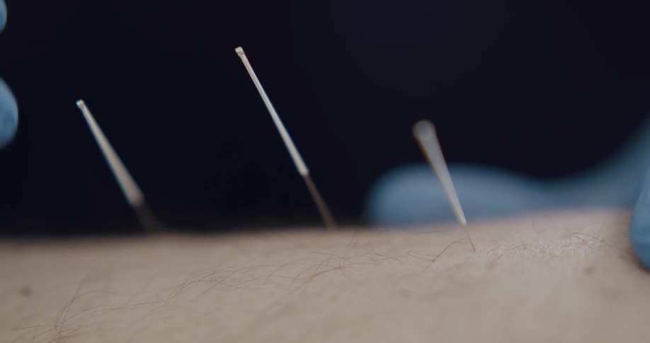 Acupuncturist wearing blue latex gloves applies needles on the skin of a patient
