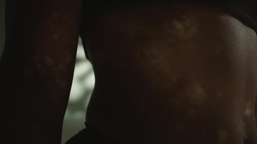 Female models belly with bra and vitiligo skin in studio