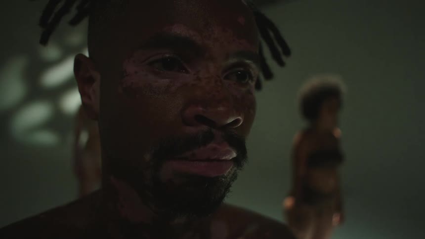 Close up of mans face with vitiligo skin and braids in front of female models in studio
