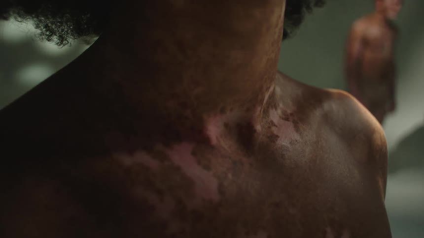 A person with vitiligo standing in a room with others