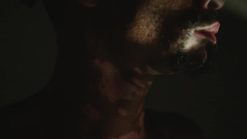 Male models throat and jaw with vitiligo skin in studio