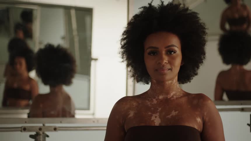 A model with vitiligo poses in her bra in a studio