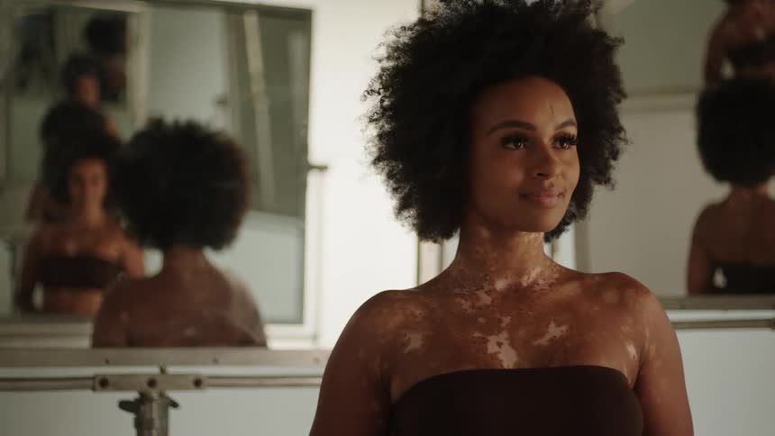 A woman with a skin condition poses in front of a mirror