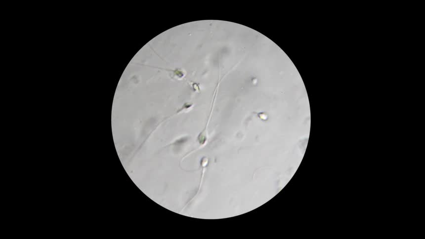Abnormal sperm is seen under a microscope