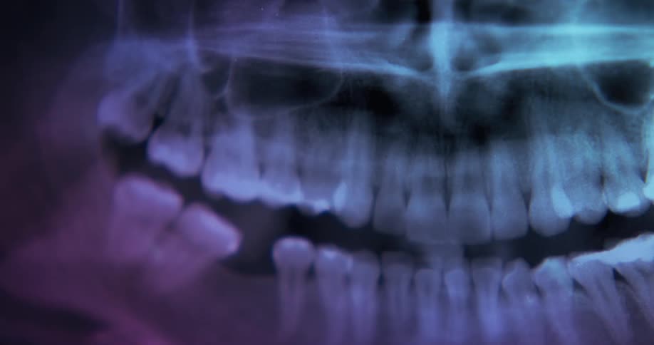 Xray view of a patients mouth is displayed