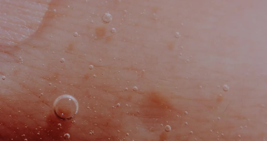 Bubbles moving and bursting in an oozing transparent liquid over human skin
