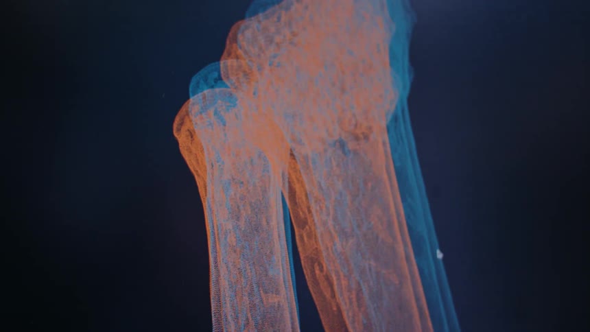 A computer rendering of forearm bones is zoomedin upon onscreen
