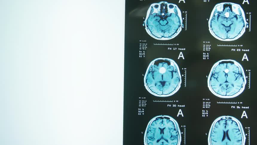 A hand puts up the images from a brainscan on a back light