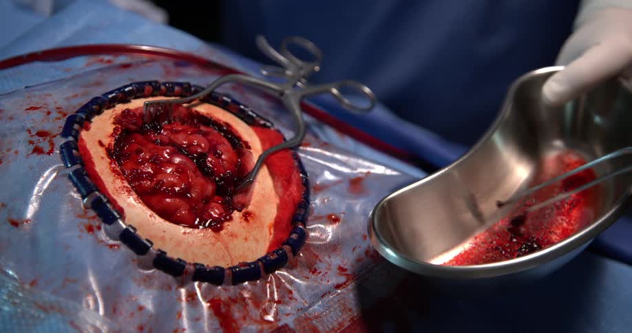 Hands of two people with gloves removing shrapnel from a patients brain in a surgical procedure
