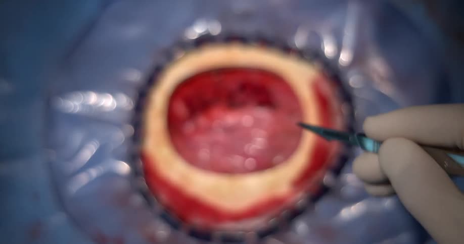 Surgeon shakes and hesitates while performing brain surgery