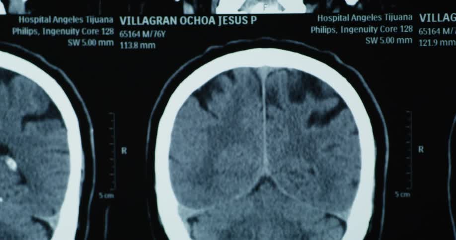 A medical brain scan shows two crosssectional images of a 76yearold male patients head likely highlighting an abnormality for diagnostic purposes