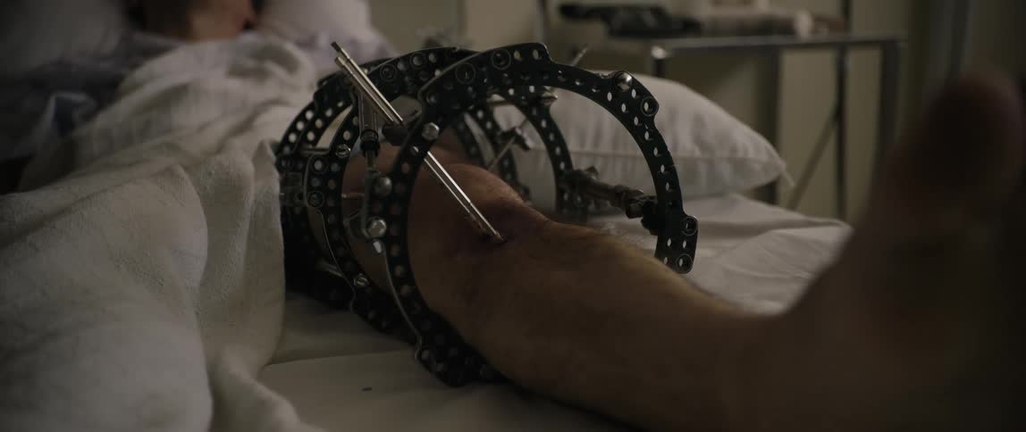 A man has a large metal brace on his leg in the hospital