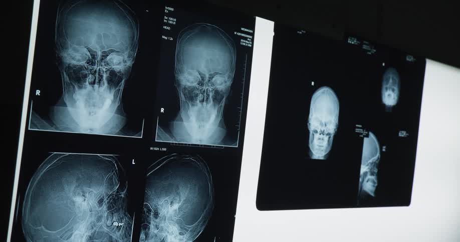 Several xray images of a persons skull viewed from different angles
