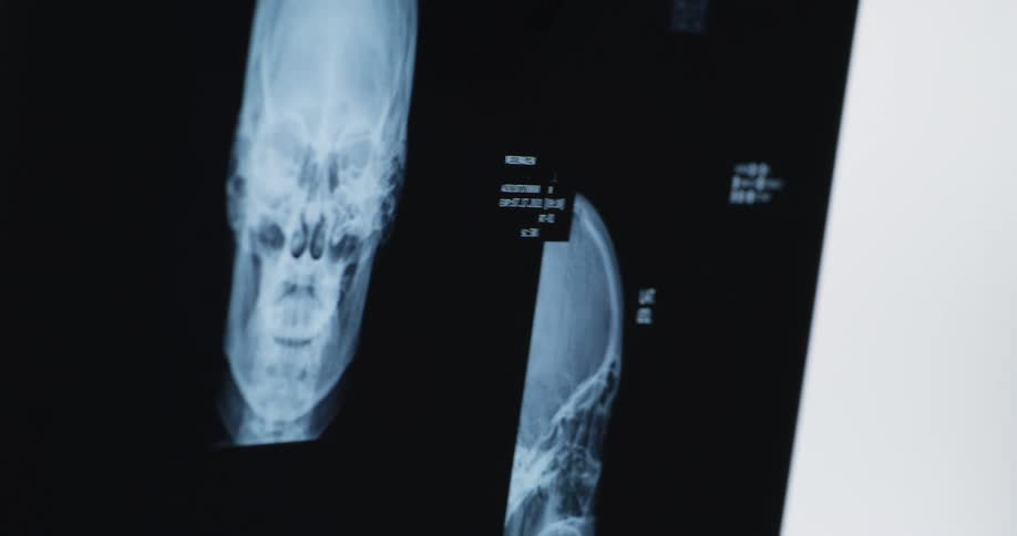 Closeup xray of a skull