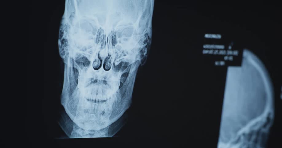 Close up of magnetic xray of a skull