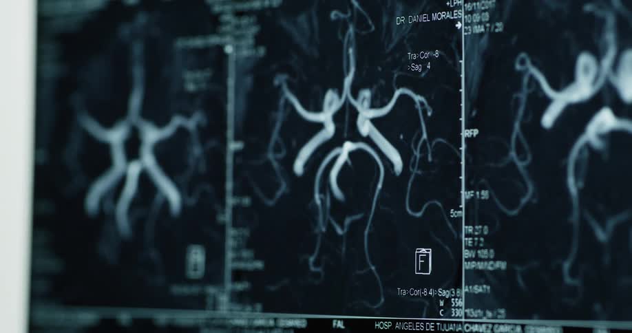 A medical scan displays detailed imagery of cerebral blood vessels