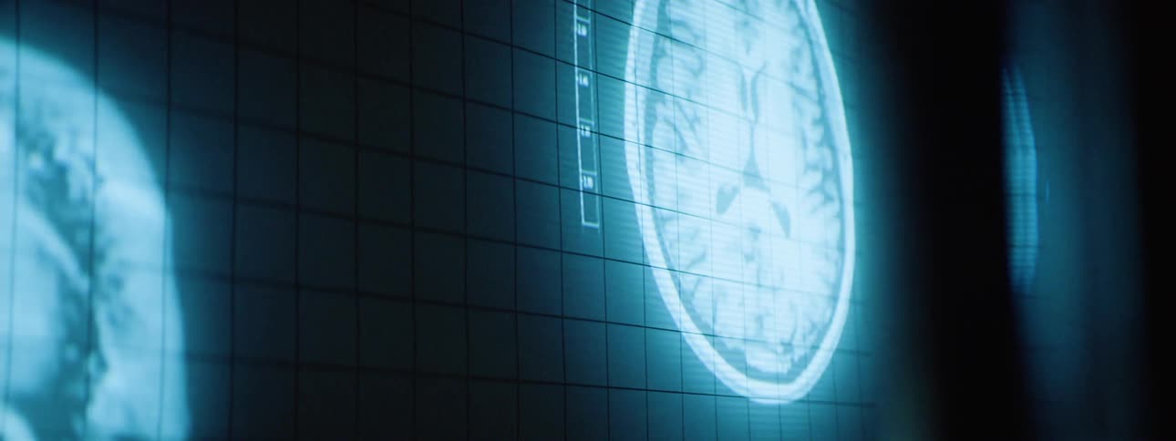 A radiology image of a brain scan displayed on a medical screen showing detailed crosssectional views of the brain in grayscale with highlighted areas for analysis