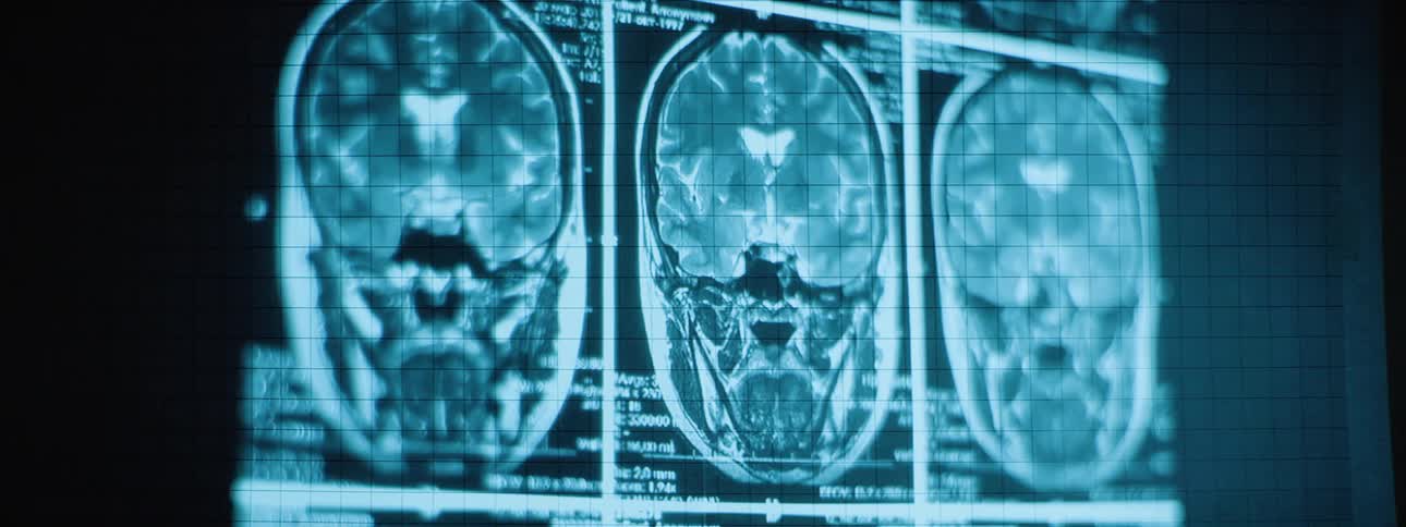 Medical imaging software displaying scans of a persons brain on a monitor