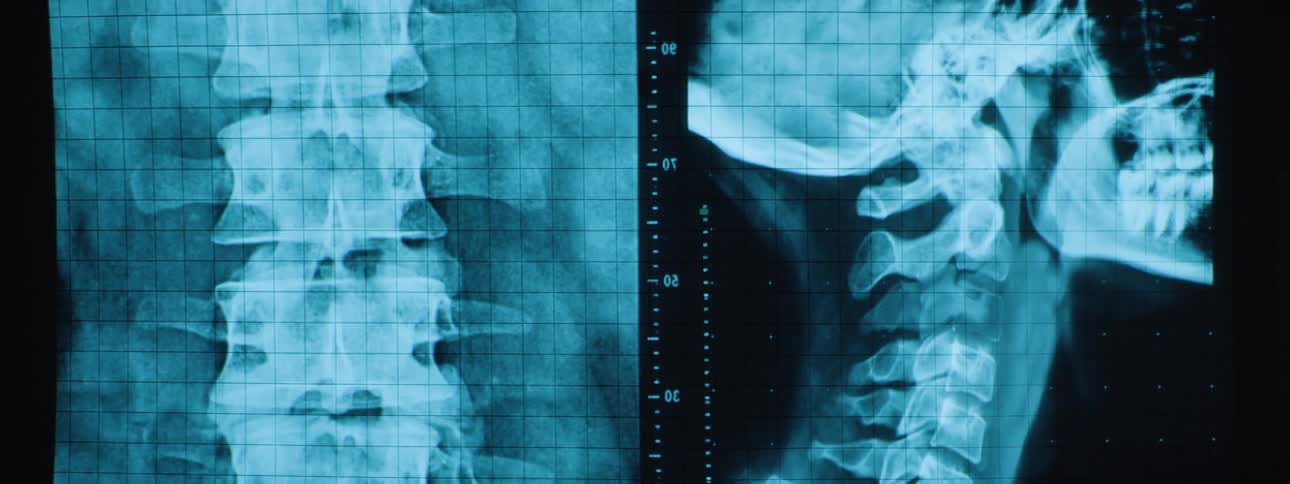 Medical imaging software displaying persons spine against a chart on monitor screen