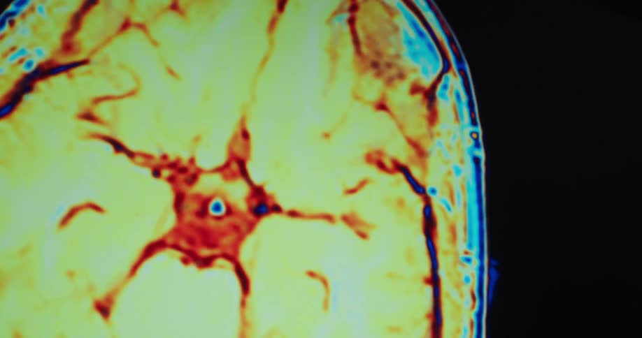 A colorful medical scan of a human head and brain rotates on a black background showing different cross sections with arteries and veins in red and blue