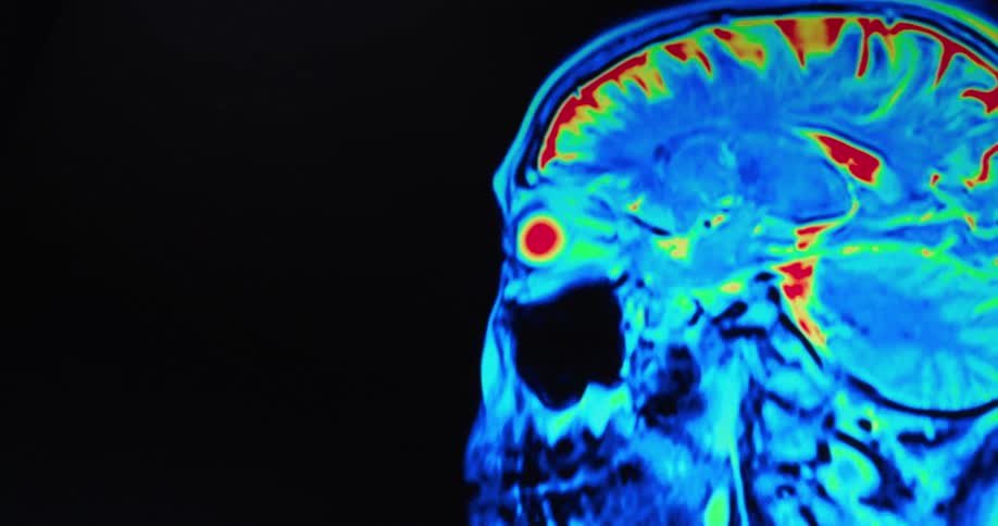 Color magnetic resonance imaging of the human brain in lateral view