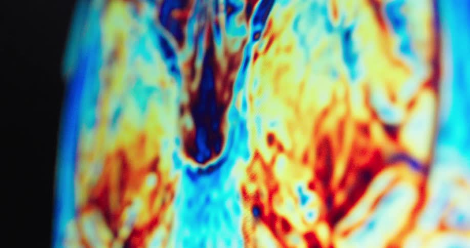 An animation of a brain mri scan displayed on a computer screen showing different sections of the brain