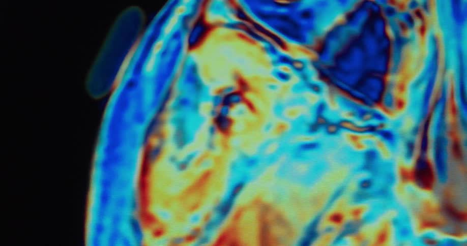 A colorful medical scan of a human head and brain rotates on a black background showing different cross sections with arteries and veins in red and blue