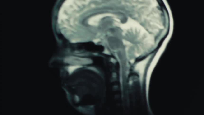 CT scan frame showing a side view of a human brain in motion with layered effect suggesting animation or moving diagnostic visualization