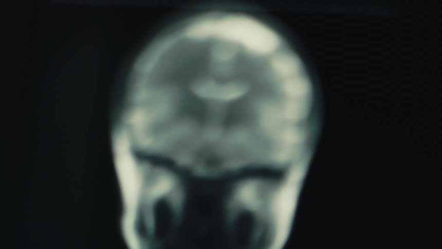 MRI scan image of a human brain appearing to flash rapidly, indicating fast movement or visual effect mimicking high-frequency activity