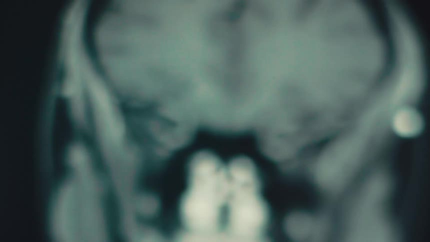 A blurry medical scan shows the outline of a human skull and brain structure