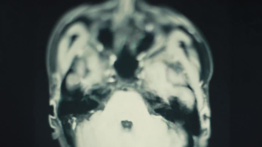 Medical brain scan image displaying intense flashing light effects across brain structure suggesting high activity or cinematic interpretation of neurological data
