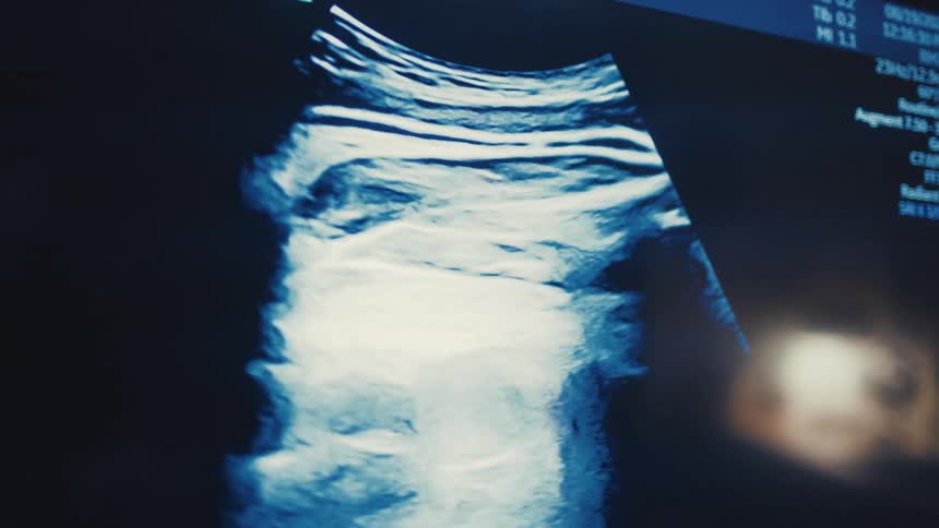 An ultrasound image with moving shapes and patterns is shown on a monitor