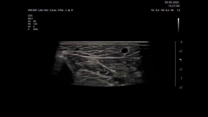 Black and white medical ultrasound scan showing internal biological tissue structures