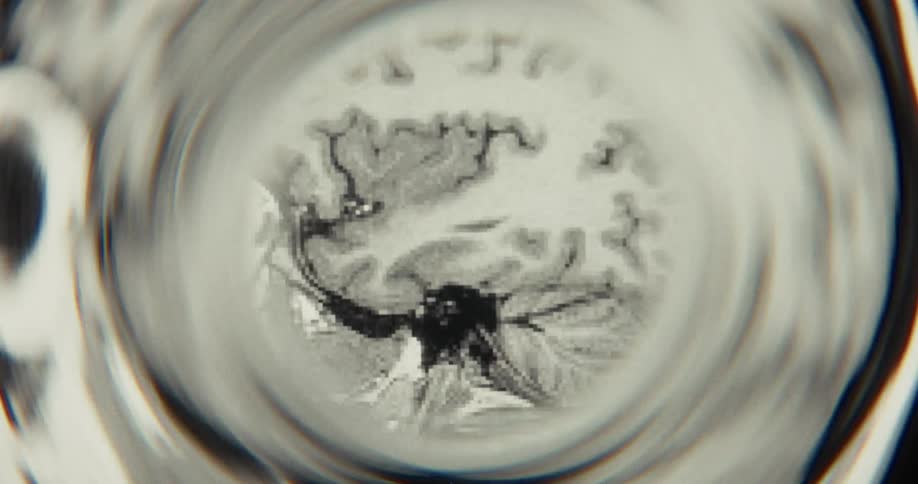 A stylized black and white MRI brain scan cycles through layers within a distorted circular frame