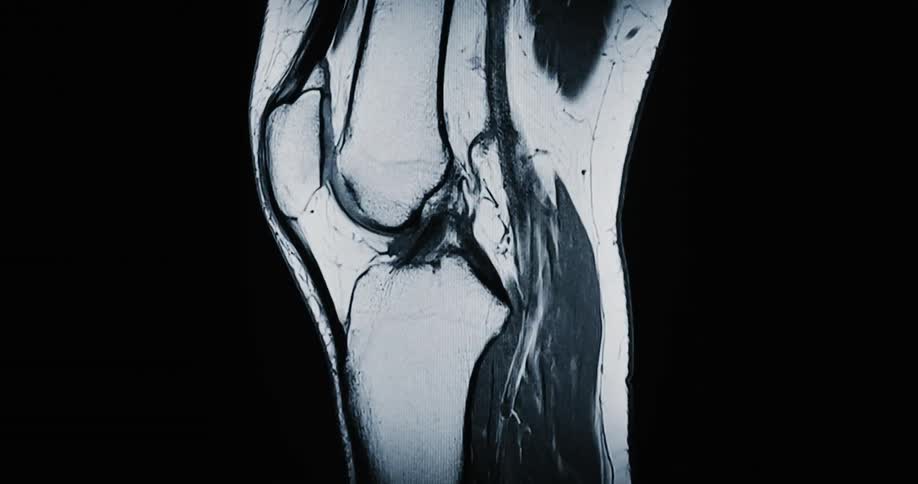 Animated magnetic resonance imaging scan revealing the internal structures of a human knee