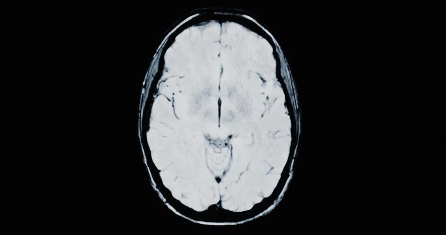 An animated, top-down MRI scan reveals the cross-sections of a human brain on a black screen