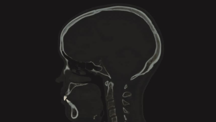 An animated sagittal CT scan of a human head reveals the intricate structures of the skull, teeth, and cervical spine