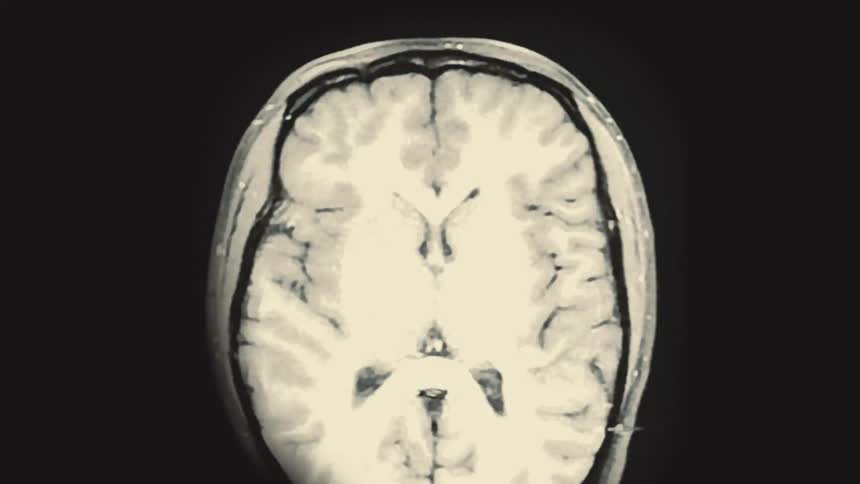 A detailed MRI scan animates through the various layers and angles of a human brain and skull