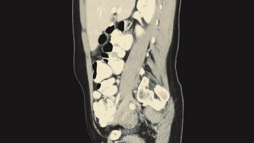 Animated coronal and sagittal views of a computed tomography scan of the human abdomen