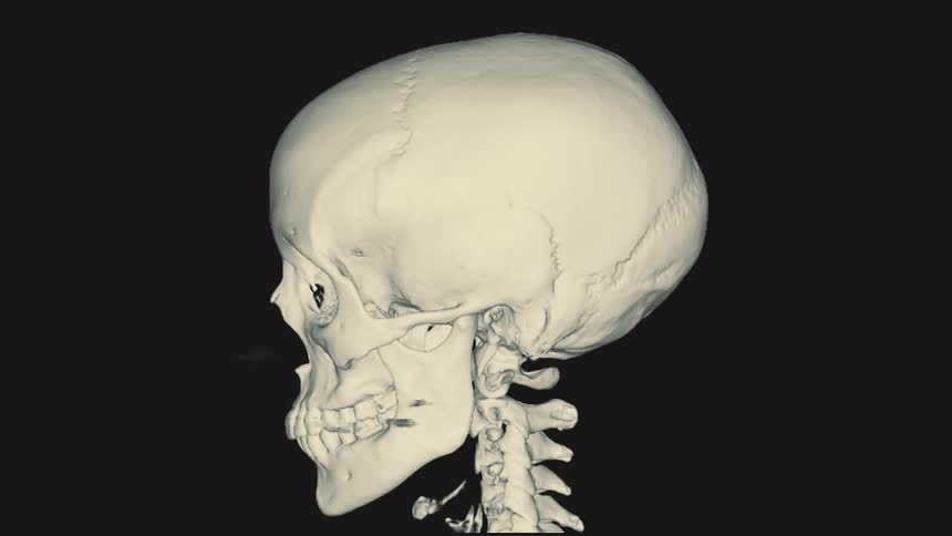 A detailed 3D computed tomography (CT) scan of a human skull and neck rotating on a black background