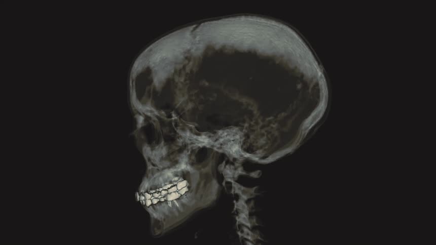 A 3D rendering of a CT scan shows a human skull and cervical spine rotating 360 degrees on a black background