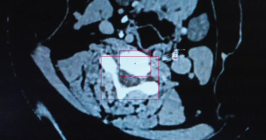 A computer uses artificial intelligence to analyze a CT scan, highlighting key areas for medical diagnosis